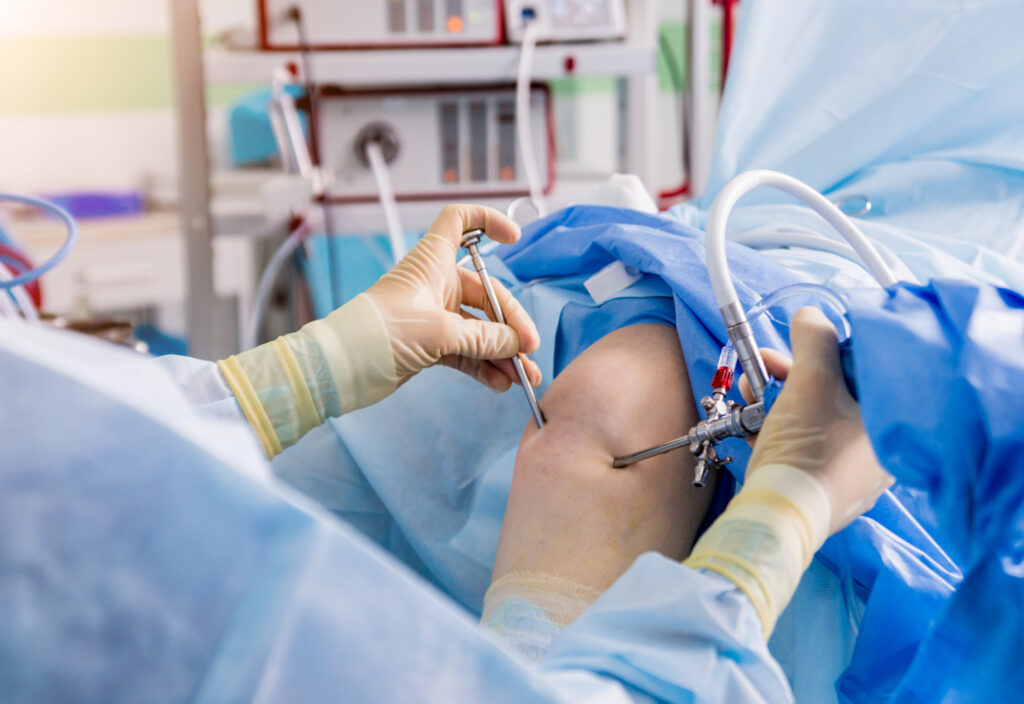 Arthroscopy